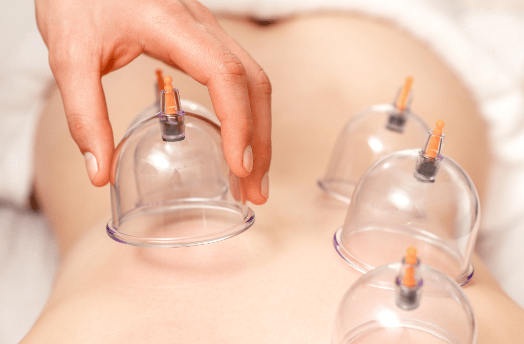 Cupping therapy applied during treatment at Muscles Care Prahran