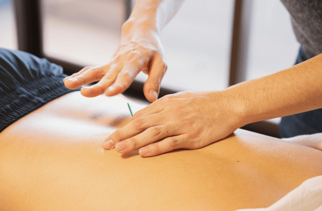 Dry needling performed by a qualified Myotherapist at Muscles Care Prahran
